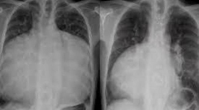 حالة نادرة... قلب رجل يملأ صدره بالكامل