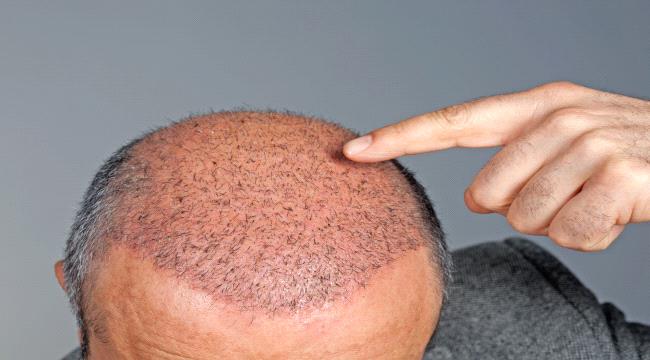 تعفن الدم .. أغرب وفاة بعد عملية زراعة شعر