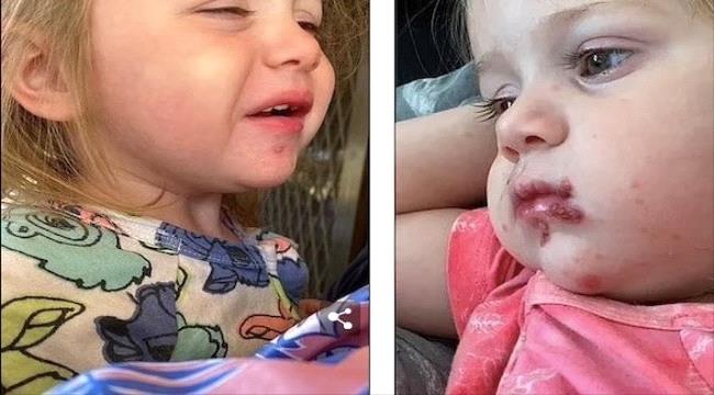 طفلة تعاني من التهابات شديدة حول فمها بسبب قبلة