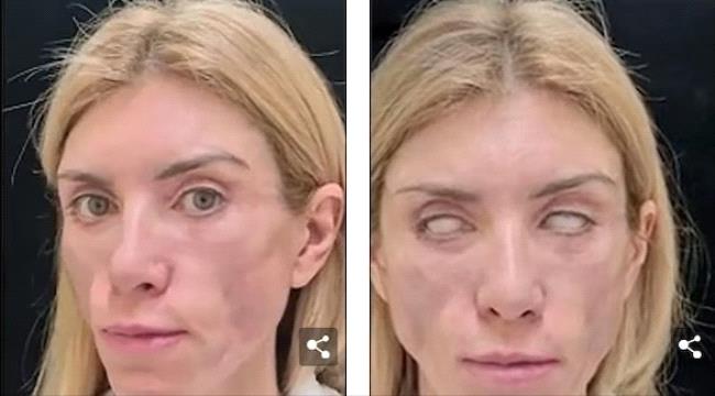 تفقد القدرة على إغلاق عينيها بسبب عملية تجميل فاشلة