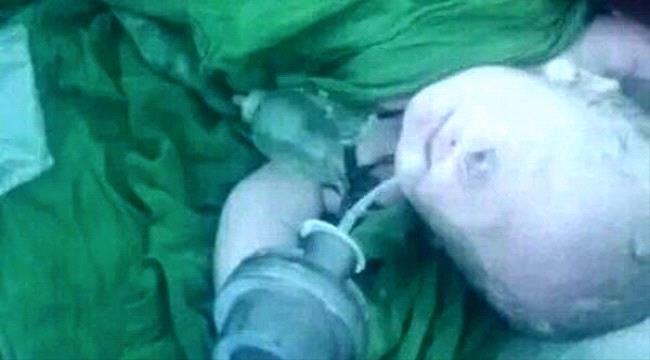حالة نادرة.. وفاة طفل يمني بعد ساعات من ولادته بـ " عين واحدة "