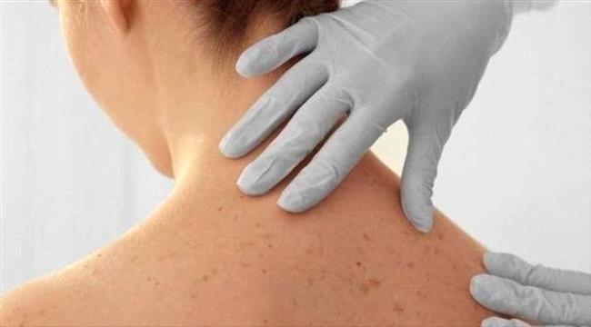 الحماية من الشمس تقي من سرطان الجلد الفاتح