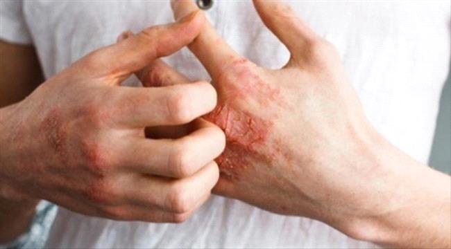 منها الحكة... أعراض الإصابة بالإكزيما