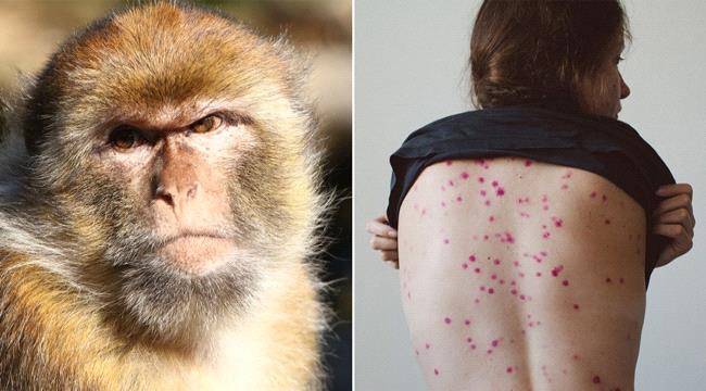 منظمة المانية تقول إنه لا يوجد داعي للذعر من فيروس جدري القرود 