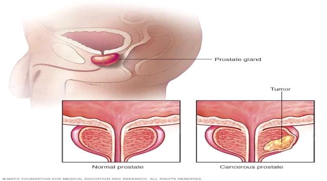 سرطان البروستاتا .. الأعراض وخطر الإصابة والتشخيص