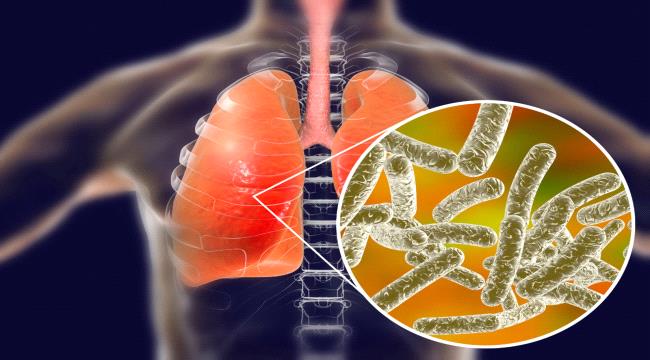 أودى بحياة 4 أشخاص في الأرجنتين.. ماذا تعرف عن داء الفيالقة؟