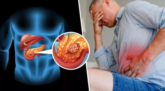 علامات مبكرة على سرطان البنكرياس