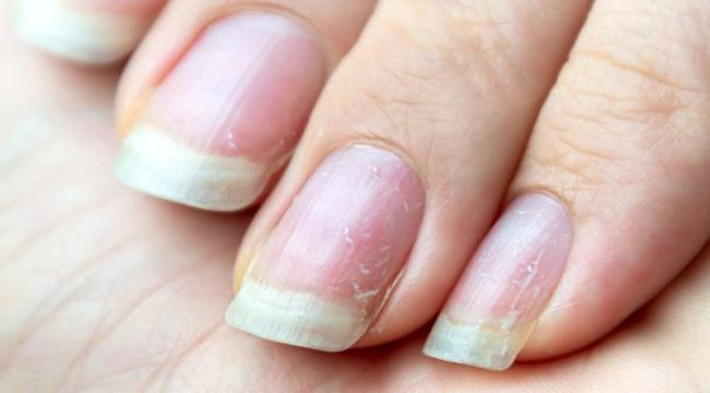 خطوط الأظافر علامة على وجود مشكلة صحية