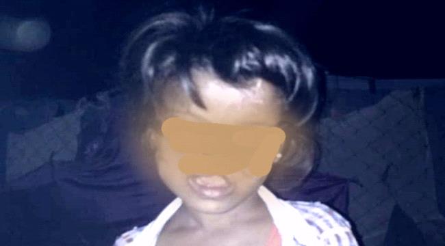 طفلة يمنية من "أبين" بحاجة لعملية لإعادة البسمة إلى وجهها