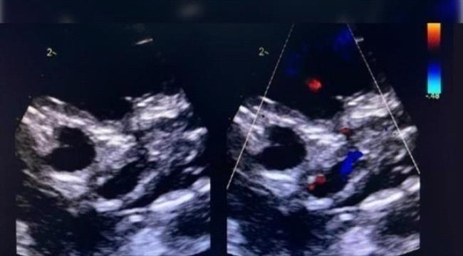 عملية تنقذ رضيعة مولودة بحالة قلب نادرة في السعودية