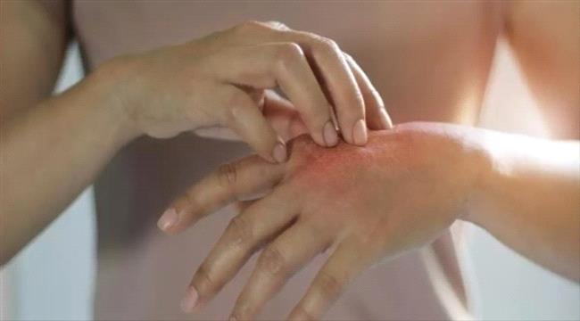 فائدة الشاي في معالجة التهاب الجلد