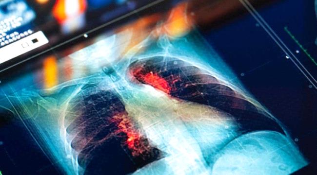 الذكاء الاصطناعي يتنبأ بسرطان الرئة لغير المدخنين
