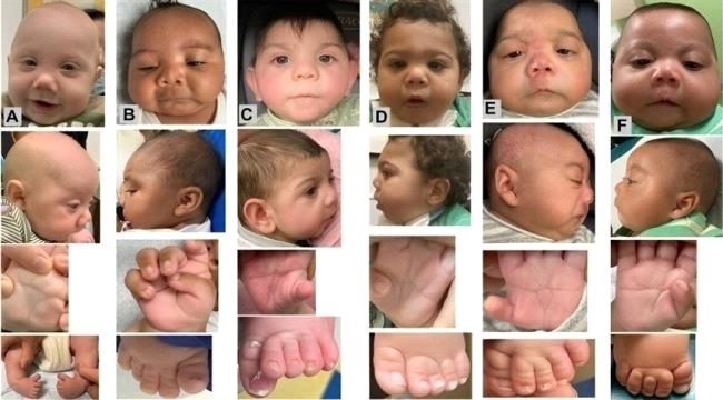 أبناء الحوامل اللاتي تناولن "فنتانيل" لديهم تشوهات