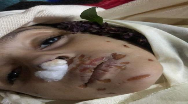 صورة.. مأساة طفلة يمنية لاقت تعذيبا وحشيا على يد زوجة أبيها حتى الموت 