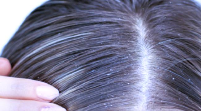 خبراء: ملايين الأشخاص معرضون لخطر الإصابة بـ"هذه المشكلة" في الرأس