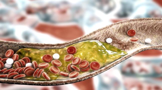 جرعة واحدة منه تكفي... دواء فعال لتخفيض الكوليسترول