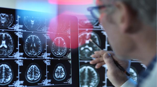 أعراض تحذيرية مبكرة تنذر بالخرف.. تعرف عليها!