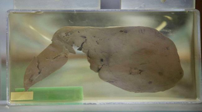 ابتكار تقنية جديدة لحماية الكبد وترميمه ذاتيا